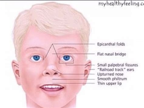 prader willi syndrome pictures infant